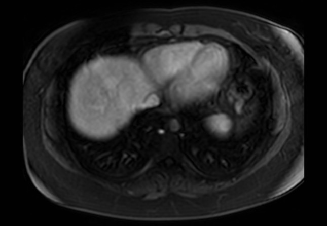 Normal liver MRI with Gadolinium (Radiopaedia 58913-66163 J 70).jpg