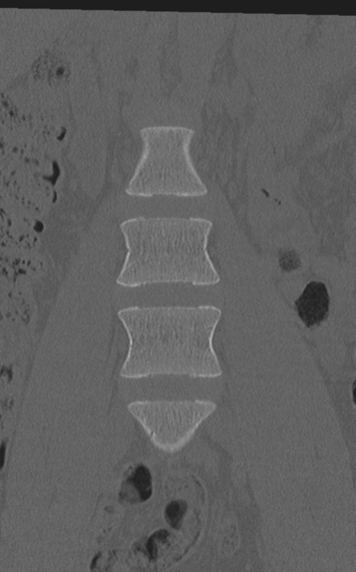 Normal lumbar spine CT (Radiopaedia 46533-50986 Coronal bone window 20).png