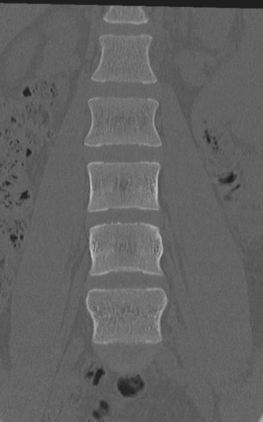 Normal lumbar spine CT (Radiopaedia 46533-50986 Coronal bone window 28).png