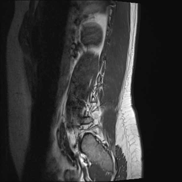 File:Normal lumbar spine MRI- 3 T (Radiopaedia 53280-59250 Sagittal T1 21).jpg