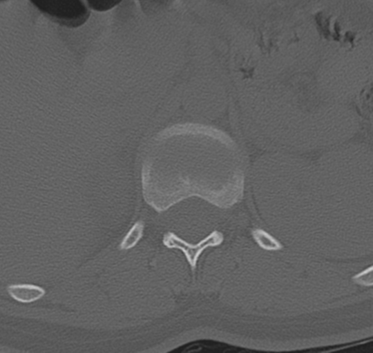 File:Normal lumbosacral CT (Radiopaedia 37923-39867 Axial bone window 24).png