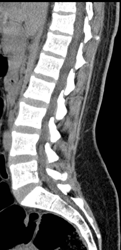 Normal lumbosacral CT (Radiopaedia 37923-39867 E 60).png