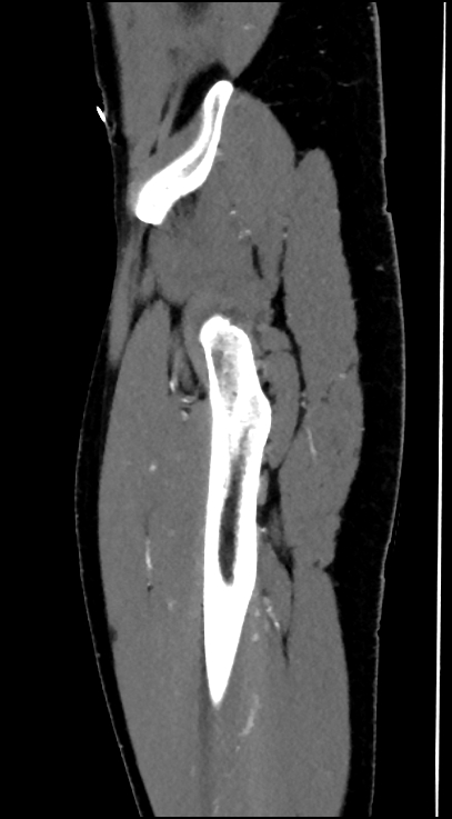 Normal pelvis CT angiogram (Radiopaedia 84966-100481 C 16).jpg