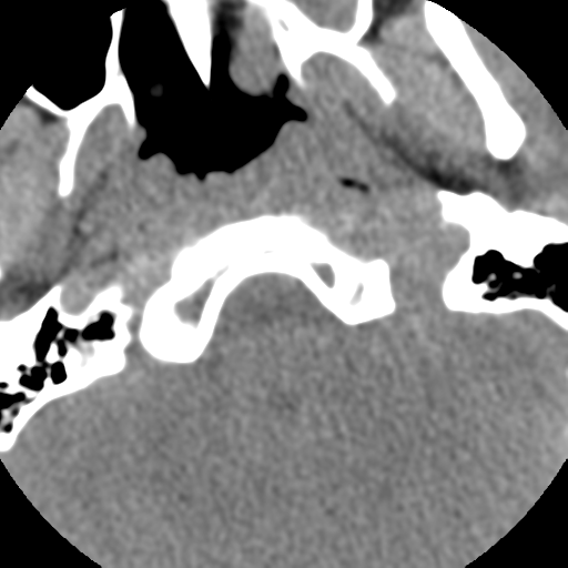 Normal trauma cervical spine (Radiopaedia 41017-43760 Axial non-contrast 5).png