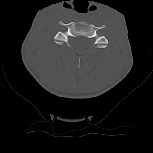 File:Normal trauma spine imaging (age 16) (Radiopaedia 45335-49358 Axial bone window 35).jpg