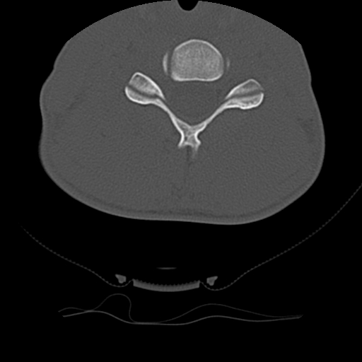 Normal trauma spine imaging (age 16) (Radiopaedia 45335-49358 Axial bone window 49).jpg