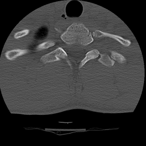 Normal trauma spine imaging (age 16) (Radiopaedia 45335-49358 Axial bone window 74).jpg