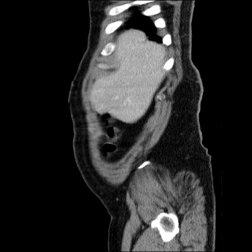 Obstructing ureteric calculus (Radiopaedia 49281-54373 C 78).jpg