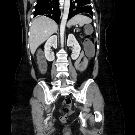 Obstructive distal colonic adenocarcinoma causing cecal perforation (Radiopaedia 86830-102989 C 120).jpg