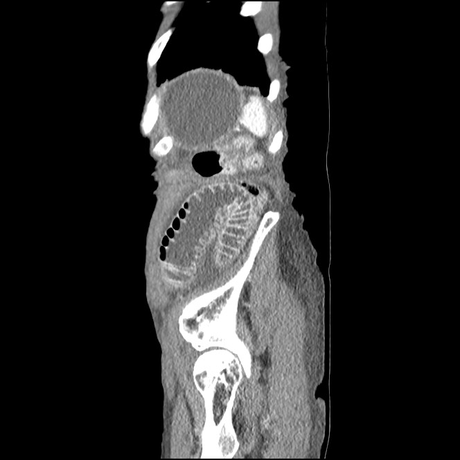 Obturator hernia causing small bowel obstruction (Radiopaedia 65522-74612 C 12).jpg