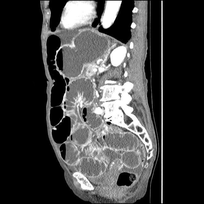 Obturator hernia causing small bowel obstruction (Radiopaedia 65522-74612 C 40).jpg