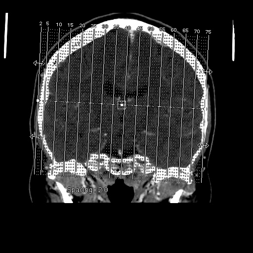 Occipital extradural hematoma simulating venous sinus thrombosis (Radiopaedia 46514-50964 D 1).jpg