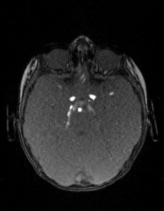Occipital horn syndrome (Radiopaedia 14255-14129 MRA 55).jpg
