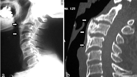 a) Recurrent ossification of anterior longitudinal ligament with anterior osteophytes arrows was present from C2 to C6 b) computed tomographic images of the cervical spine