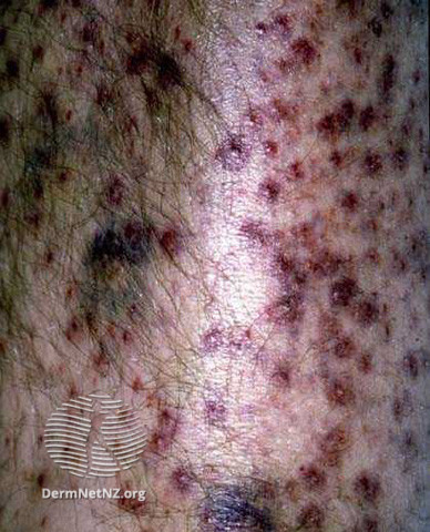 File:Perifollicular haemorrhagic papules (DermNet NZ systemic-scpap).jpg
