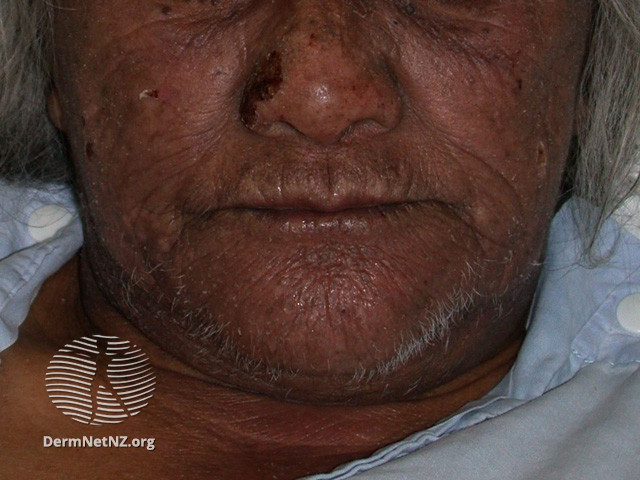 File:(DermNet NZ dermatitis-acd-face-2436).jpg