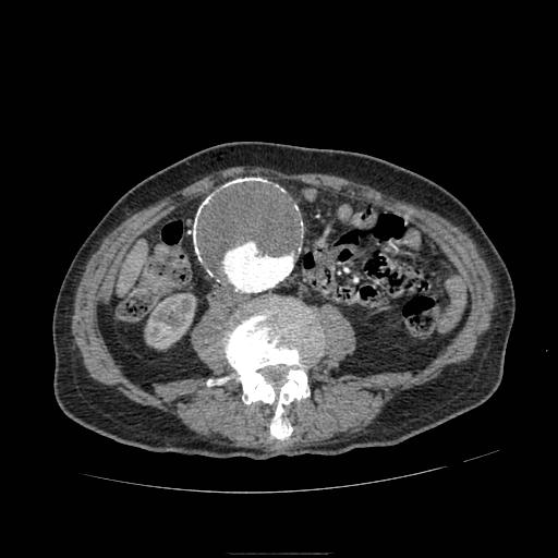 Abdominal aortic aneurysm (Radiopaedia 13341-13340 Axial C+ arterial phase 114).jpg