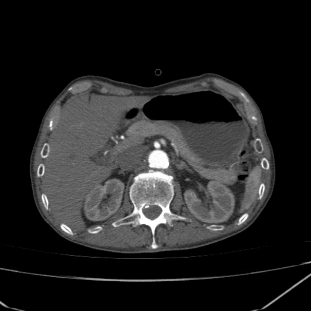 Abdominal aortic aneurysm (Radiopaedia 23703-23856 Axial C+ arterial phase 18).jpg