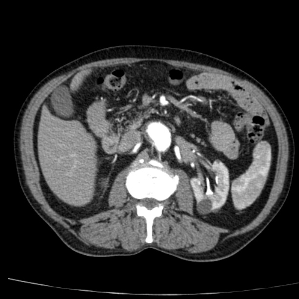 Abdominal aortic aneurysm (Radiopaedia 29248-29660 Axial C+ arterial phase 34).jpg