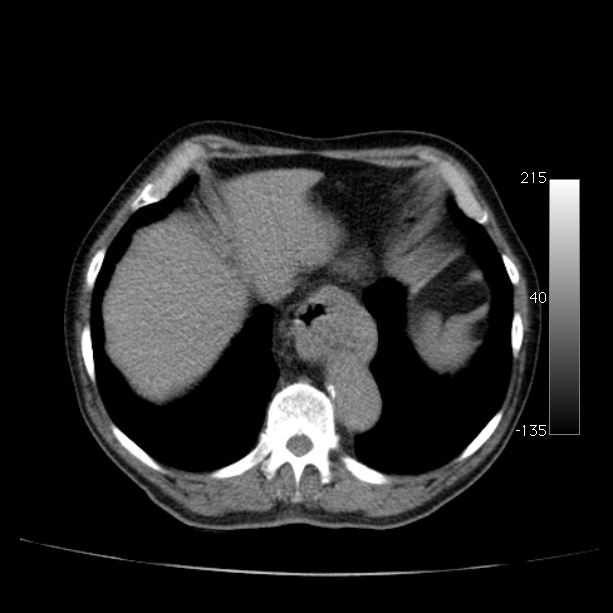 Abdominal aortic aneurysm (Radiopaedia 29248-29660 Axial non-contrast 9).jpg