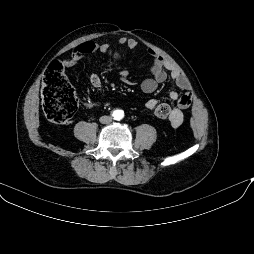 Abdominal aortic aneurysm (Radiopaedia 67117-76452 Axial C+ arterial phase 86).jpg