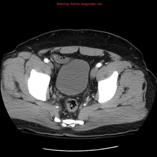 File:Abdominal aortic aneurysm (Radiopaedia 8190-9038 Axial C+ arterial phase 74).jpg