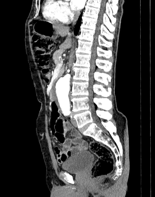 Abdominal aortic aneurysm (Radiopaedia 83581-98689 Sagittal C+ arterial phase 42).jpg