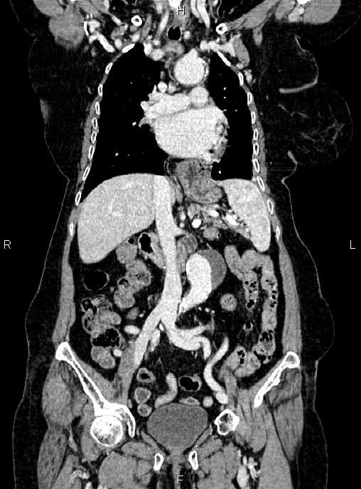 Abdominal aortic aneurysm (Radiopaedia 85063-100606 Coronal C+ arterial phase 26).jpg