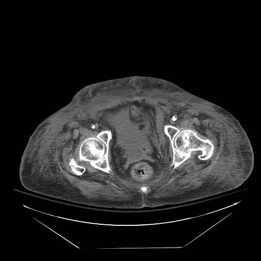 Abdominal aortic aneurysm - impending rupture (Radiopaedia 19233-19247 Axial non-contrast 156).jpg