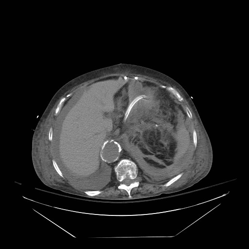 Abdominal aortic aneurysm - impending rupture (Radiopaedia 19233-19247 Axial non-contrast 45).jpg