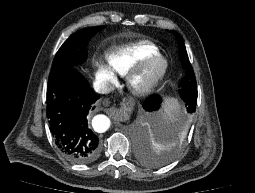 Abdominal aortic aneurysm rupture (Radiopaedia 54179-60362 Axial C+ arterial phase 17).jpg