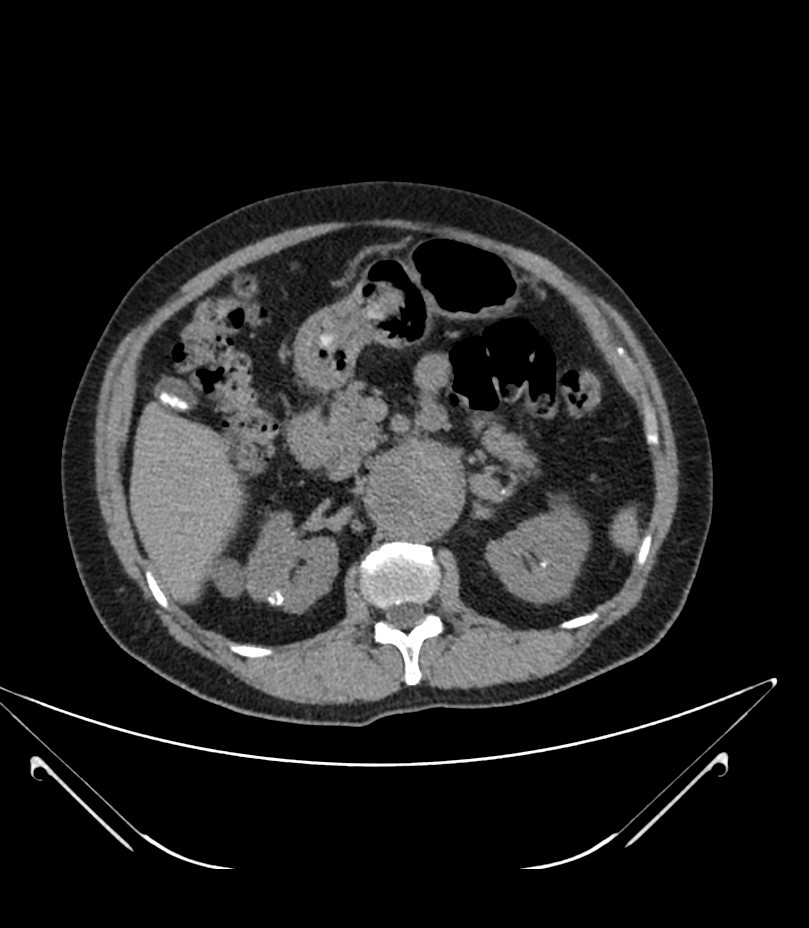Abdominal aortic aneurysm with thrombus fissuration (Radiopaedia 46218-50618 Axial non-contrast 18).jpg