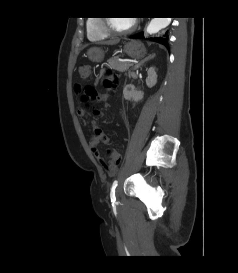 Abdominal aortic aneurysm with thrombus fissuration (Radiopaedia 46218-50618 Sagittal C+ arterial phase 40).jpg