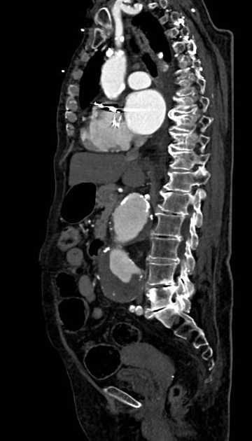 Abdominal aortic aneurysm with thrombus fissuration (Radiopaedia 73192-83919 Sagittal C+ arterial phase 74).jpg