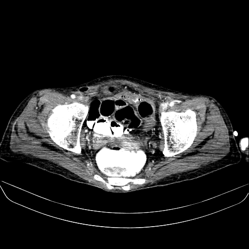 File:Abdominal collection due to previous cecal perforation (Radiopaedia 80831-94320 Axial C+ portal venous phase 186).jpg