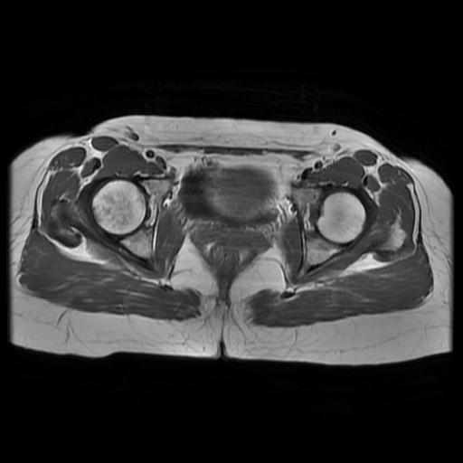 File:Abdominal wall endometriosis (Radiopaedia 83702-98847 Axial T1 14).jpg