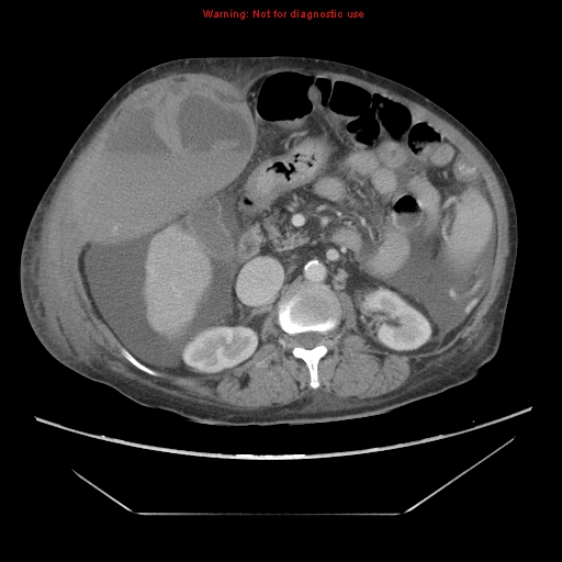 File:Abdominal wall hematoma (Radiopaedia 9427-10112 Axial C+ portal venous phase 43).jpg