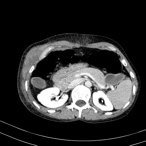 Abdominal wall hematoma with active bleeding (Radiopaedia 83915-99117 Axial C+ portal venous phase 13).jpg