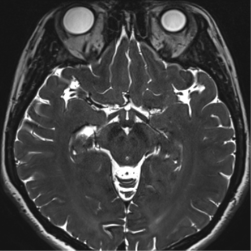 Abducens nerve palsy (Radiopaedia 51069-56648 Axial T2 fat sat 74).png
