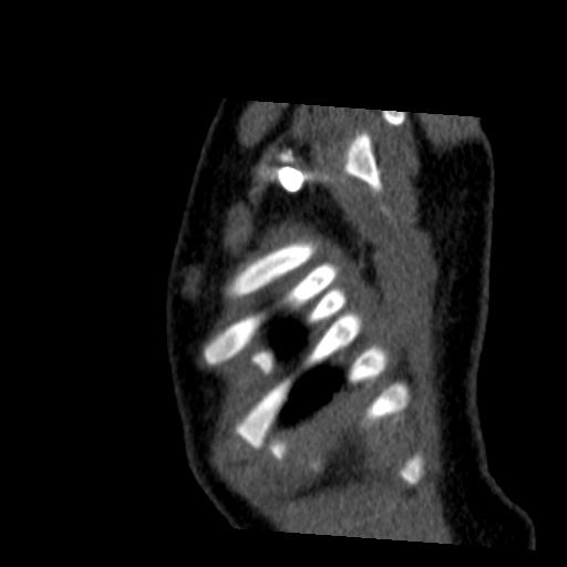 File:Aberrant left pulmonary artery (pulmonary sling) (Radiopaedia 42323-45435 Sagittal C+ arterial phase 53).jpg