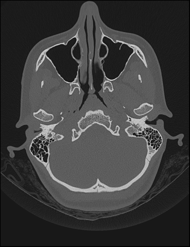 Aberrant right internal carotid artery (Radiopaedia 65191-74198 Axial non-contrast 24).jpg