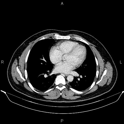 File:Aberrant right subclavian artery (Radiopaedia 87093-103354 Axial With contrast 67).jpg