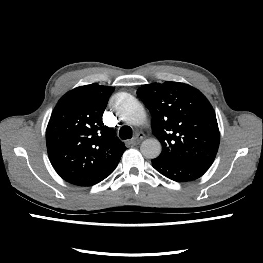 Accessory left horizontal fissure with lingular pneumonia (Radiopaedia 53763-59843 Axial C+ CTPA 32).jpg