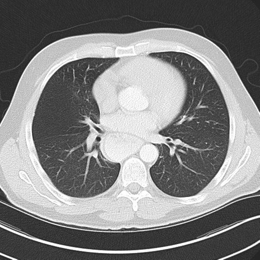 Achalasia of the cardia (Radiopaedia 38497-40595 Axial lung window 29).png