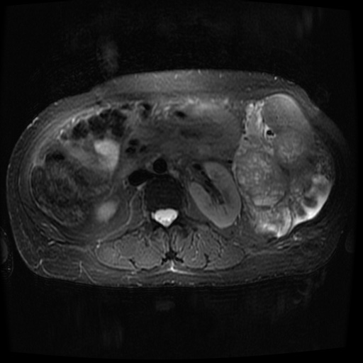 Acinar cell carcinoma of the pancreas (Radiopaedia 75442-86668 Axial T2 fat sat 45).jpg