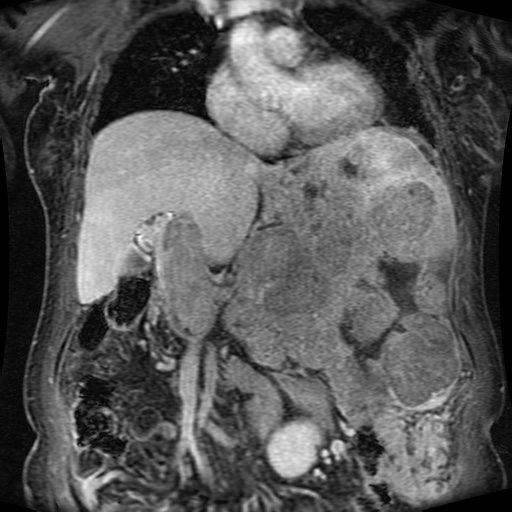 Acinar cell carcinoma of the pancreas (Radiopaedia 75442-86668 Coronal T1 C+ fat sat 116).jpg