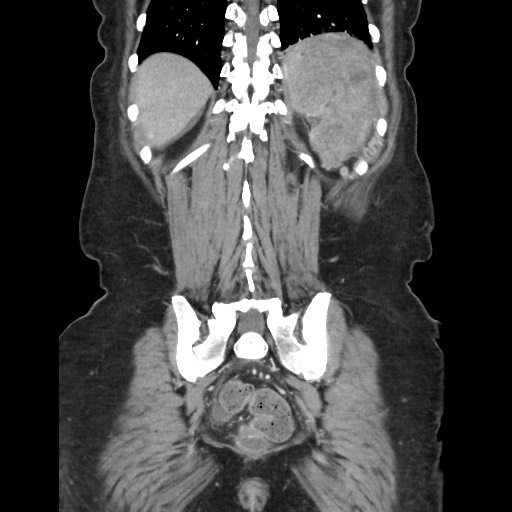 File:Acinar cell carcinoma of the pancreas (Radiopaedia 75442-86669 Coronal C+ portal venous phase 103).jpg