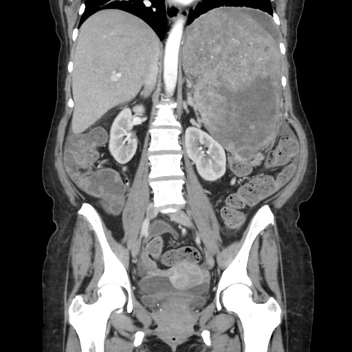 Acinar cell carcinoma of the pancreas (Radiopaedia 75442-86669 Coronal C+ portal venous phase 74).jpg