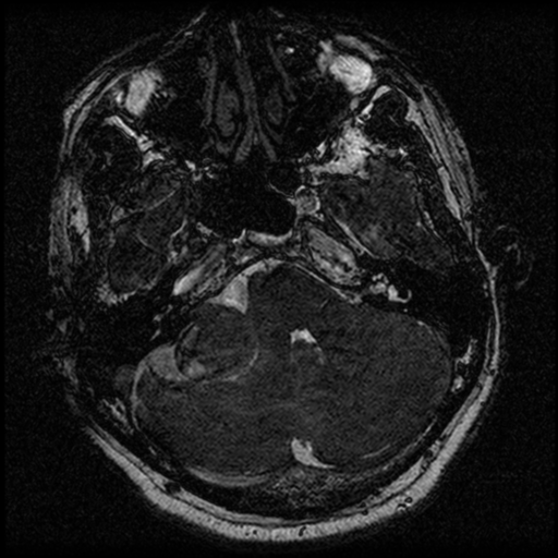 File:Acoustic schwannoma (Radiopaedia 39170-41387 Axial FIESTA 62).png