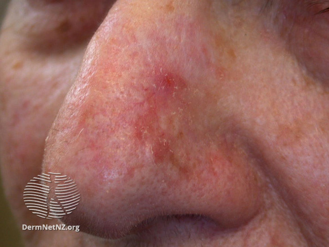 Actinic Keratoses affecting the face (DermNet NZ lesions-ak-face-425).jpg